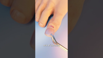 Thumbnail for How Toenail Removal Works 😳 | Zack D. Films