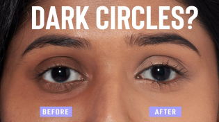 Thumbnail for Home remedies to remove dark circles QUICKLY and NATURALLY! | Glamrs by Purplle